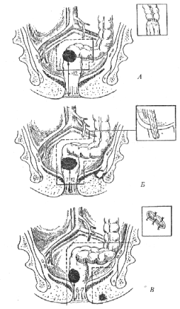 операция при раке прямой кишки